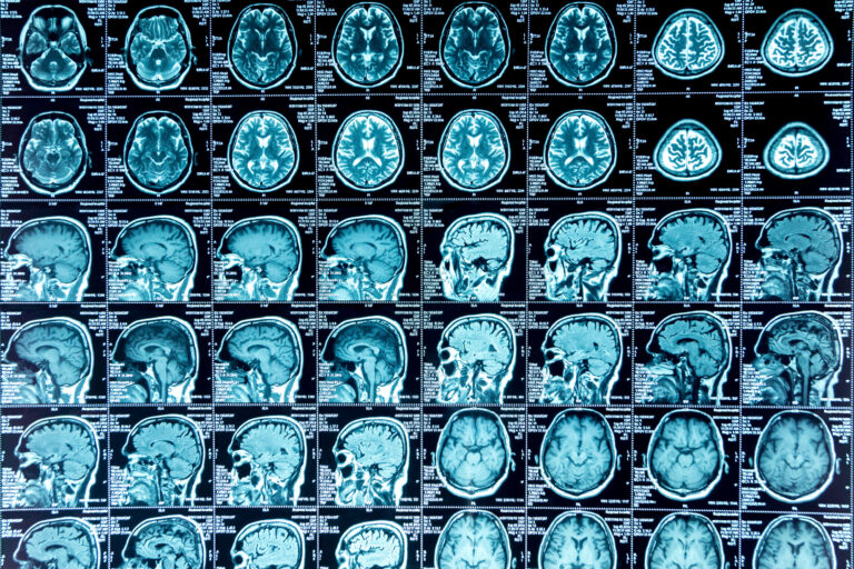 Huntington Beach Brain Injury Lawyer 