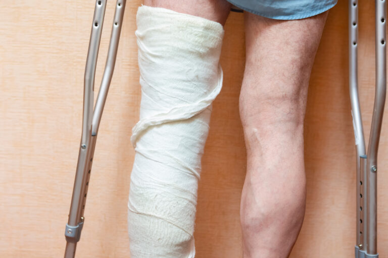 Santa Monica Bone Fractures Lawyer