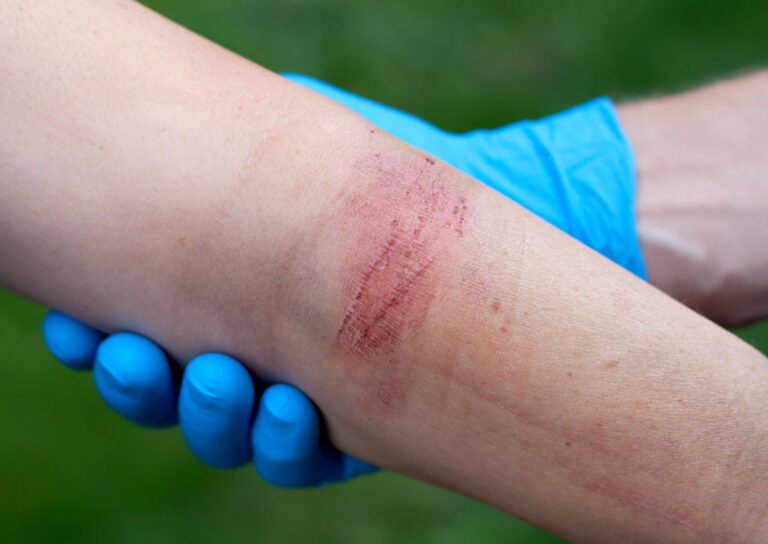 Pasadena Burn Injuries Lawyer
