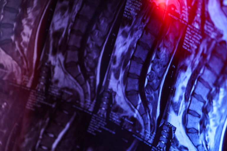 San Bernardino Spinal Injury Lawyer