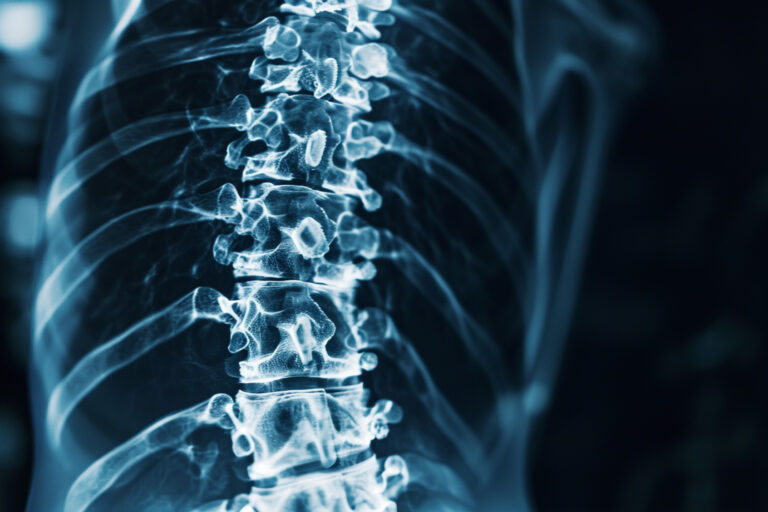 Rancho Cucamonga Spinal Injury Lawyer