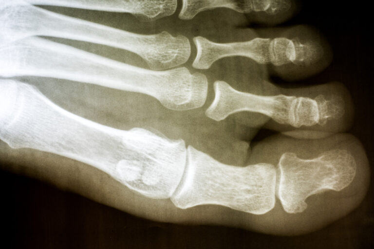 Rancho Cucamonga Bone Fractures Lawyer