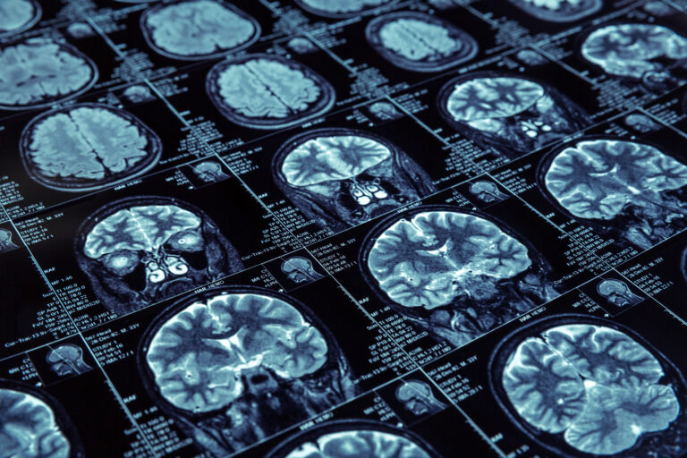 Victorville Brain Injury Lawyer
