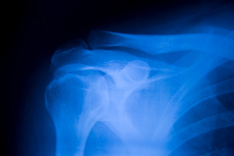 San Bernardino Bone Fractures Lawyer