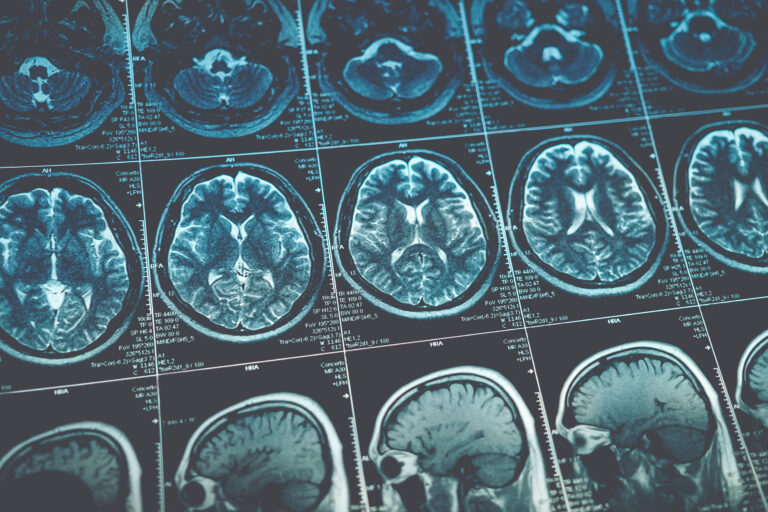 San Bernardino Brain Injury Lawyer