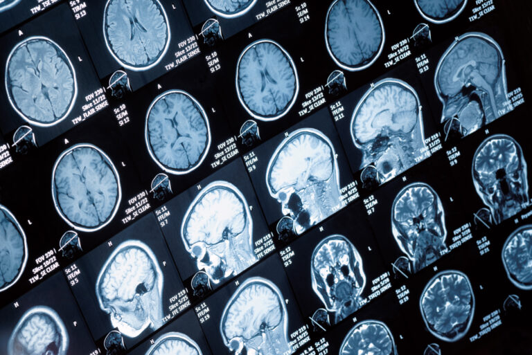 Tempe Brain Injury Lawyer